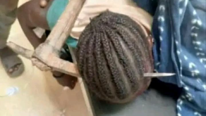 Burkina Faso : Ouahigouya, une patiente opérée avec succès au CHUR après une agression par arme métallique