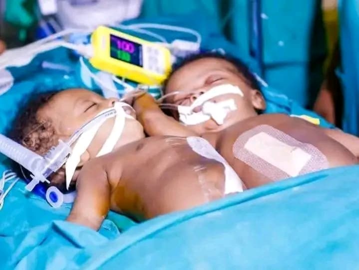 Burundi : Deux bébés siamois de 3 mois séparés avec succès