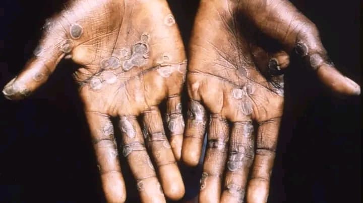 Côte d'Ivoire : L'État donne l'alerte sur l'épidémie de la variole du singe